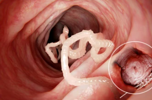 Tapeworm In Intestine